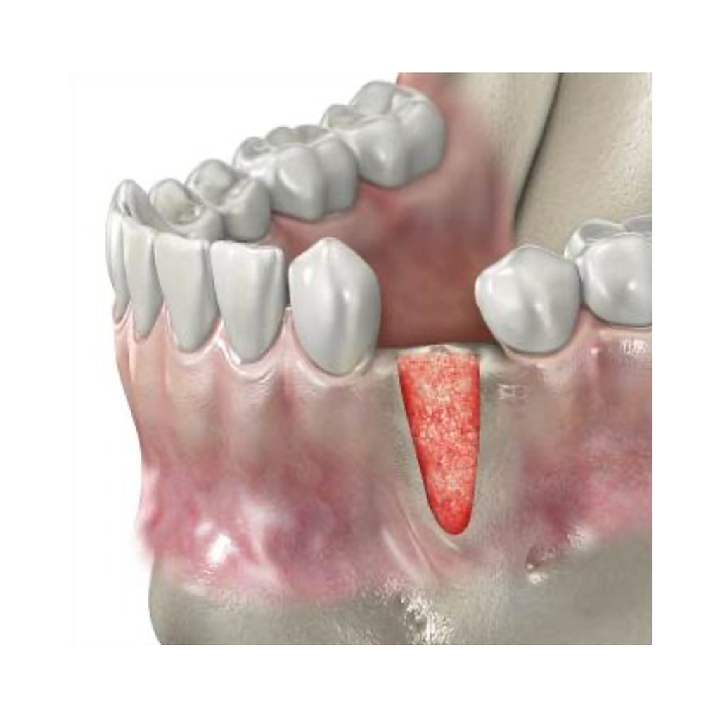 UBGEN-Bone-Substitutes-AVPMedTech-RE-BONE_1