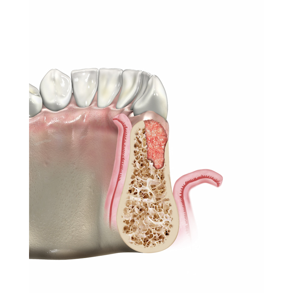 UBGEN-Bone-Substitutes-AVPMedTech-RE-BONE_2