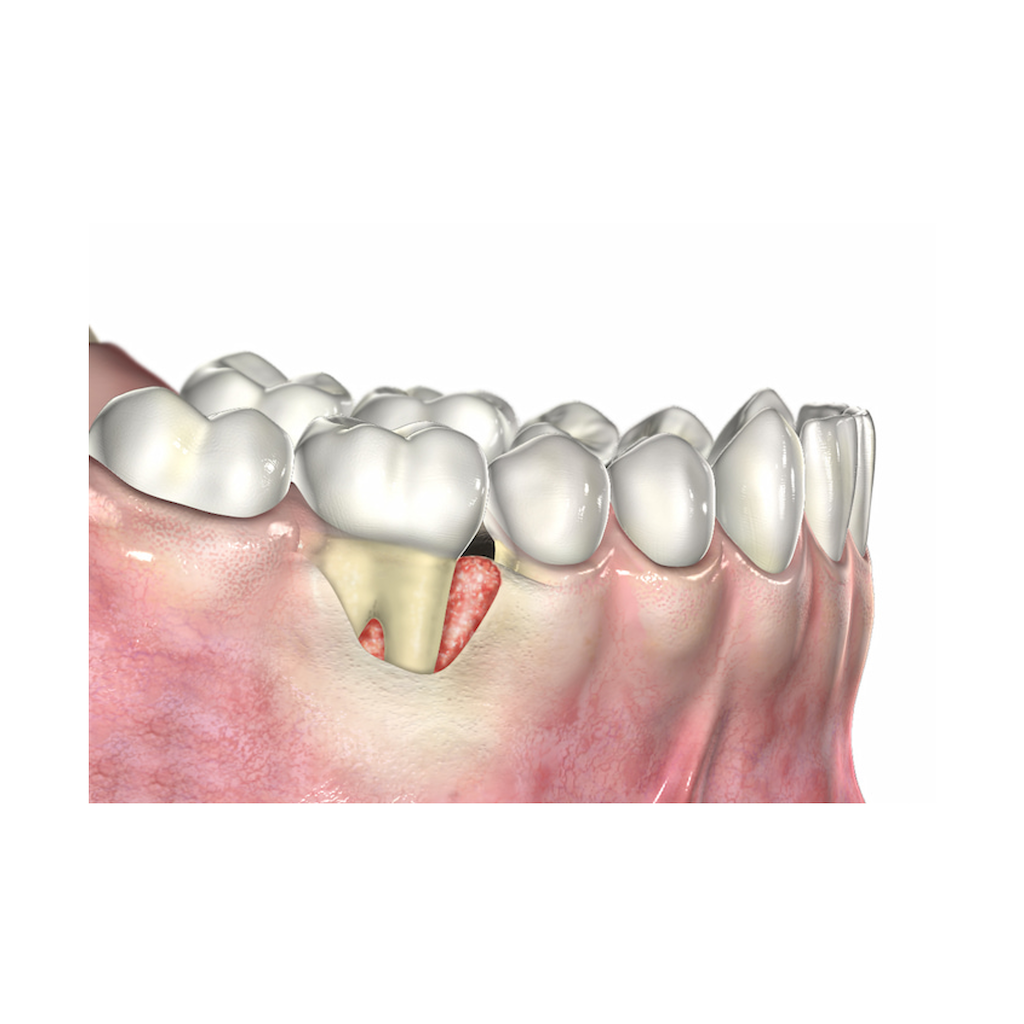 UBGEN-Bone-Substitutes-AVPMedTech-RE-BONE_3