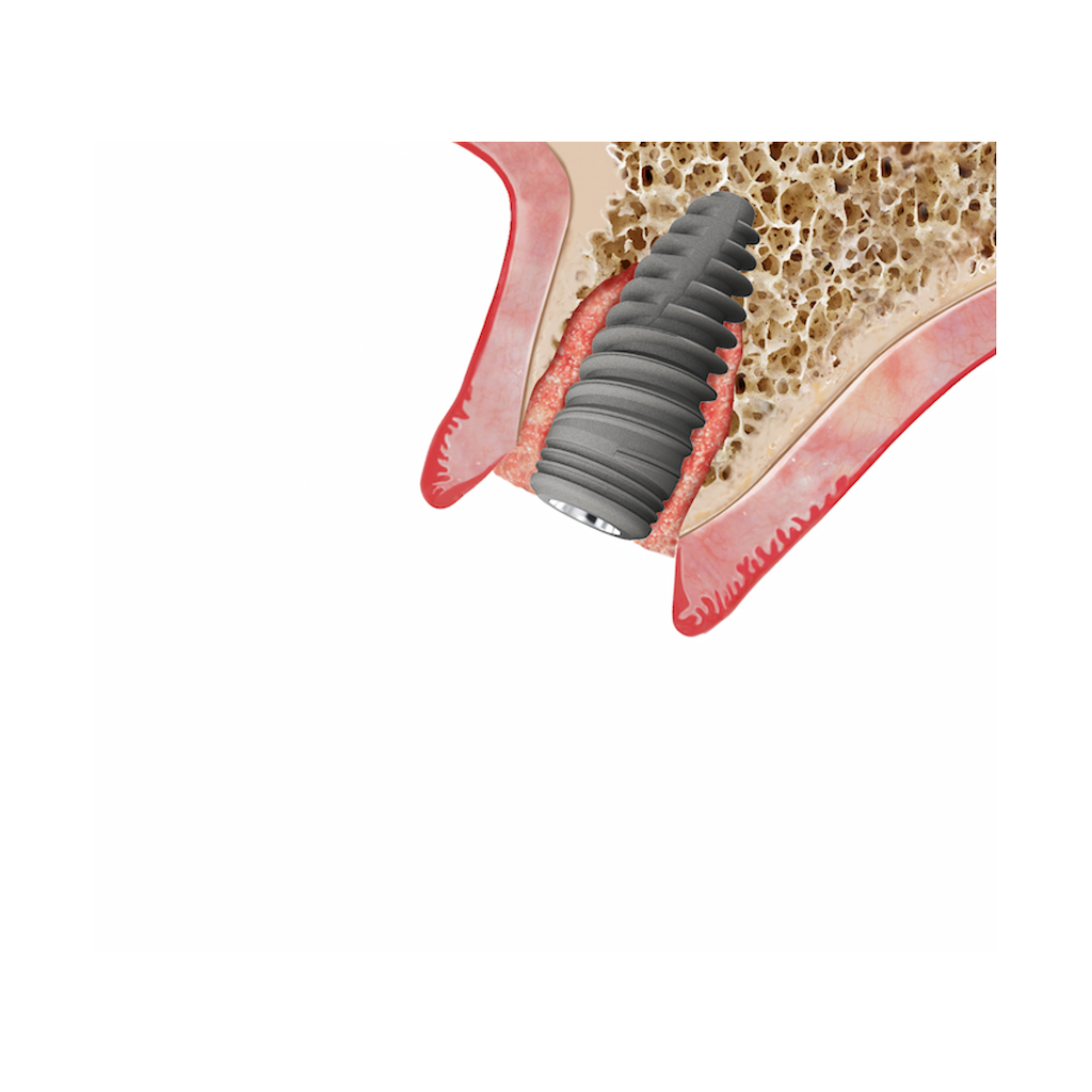 UBGEN-Bone-Substitutes-AVPMedTech-RE-BONE_4