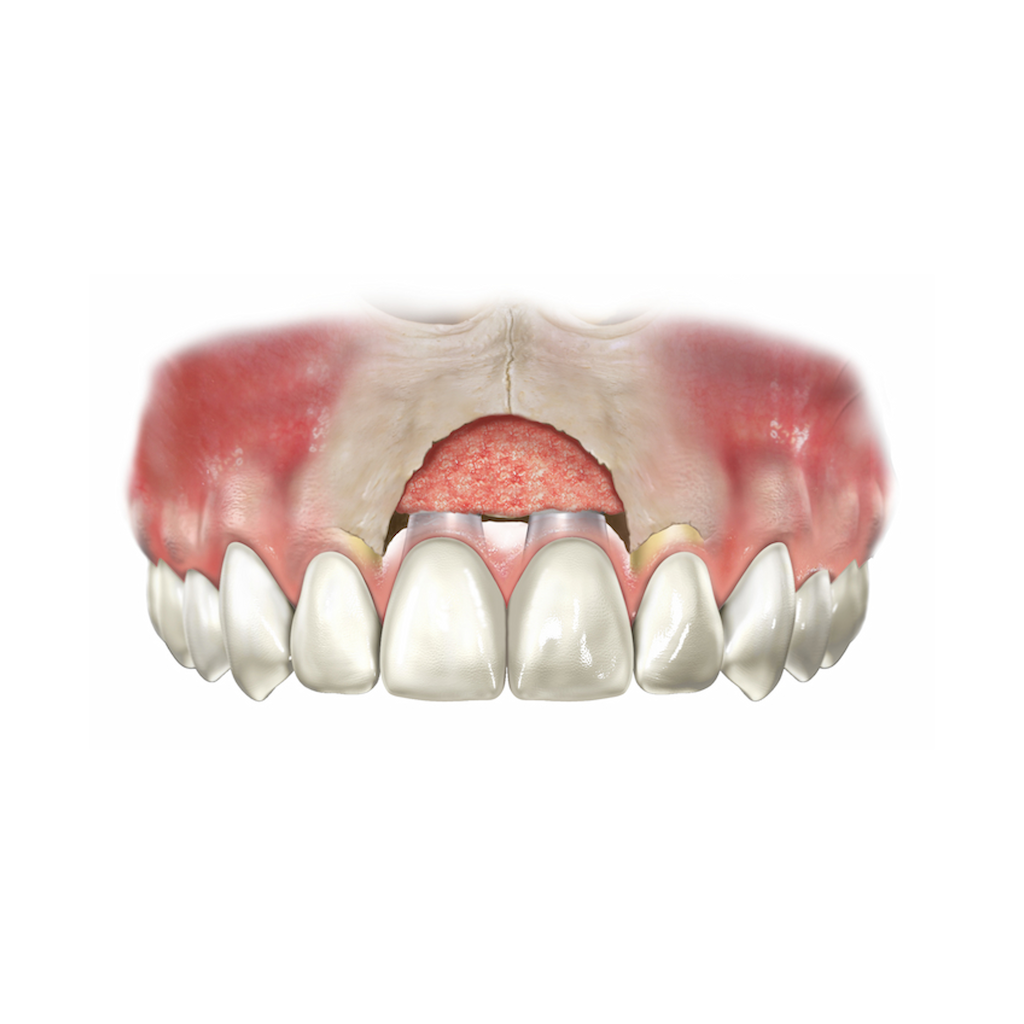 UBGEN-Bone-Substitutes-AVPMedTech-RE-BONE_5