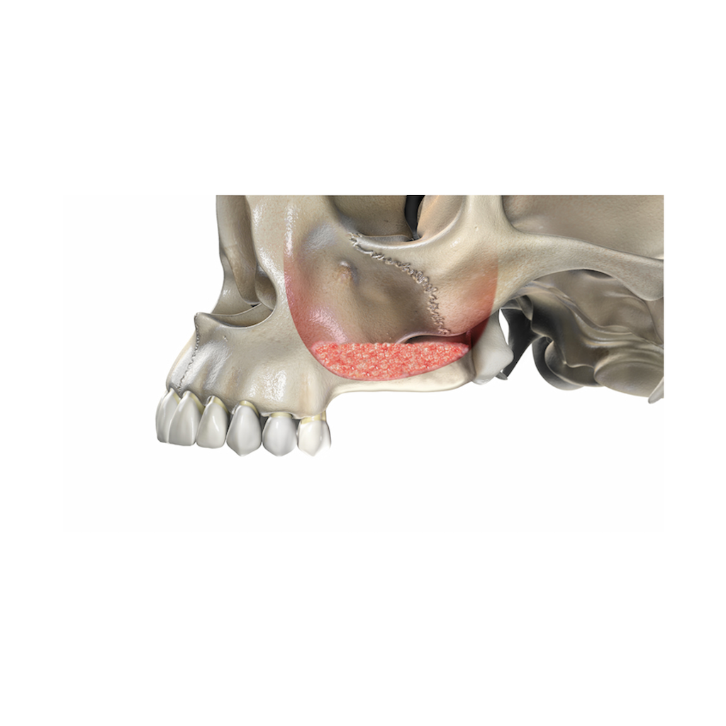 UBGEN-Bone-Substitutes-AVPMedTech-RE-BONE_6