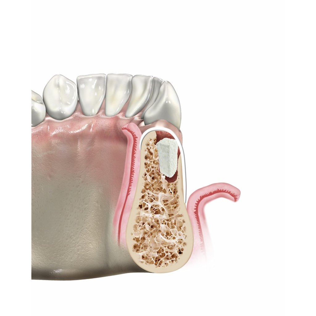 UBGEN-Bone-Substitutes-AVPMedTech-SHELTER_1