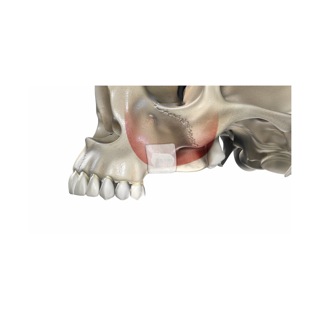 UBGEN-Bone-Substitutes-AVPMedTech-SHELTER_2