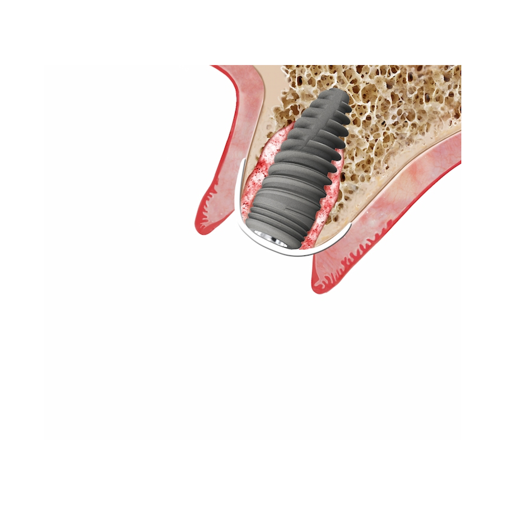UBGEN-Bone-Substitutes-AVPMedTech-SHELTER_3