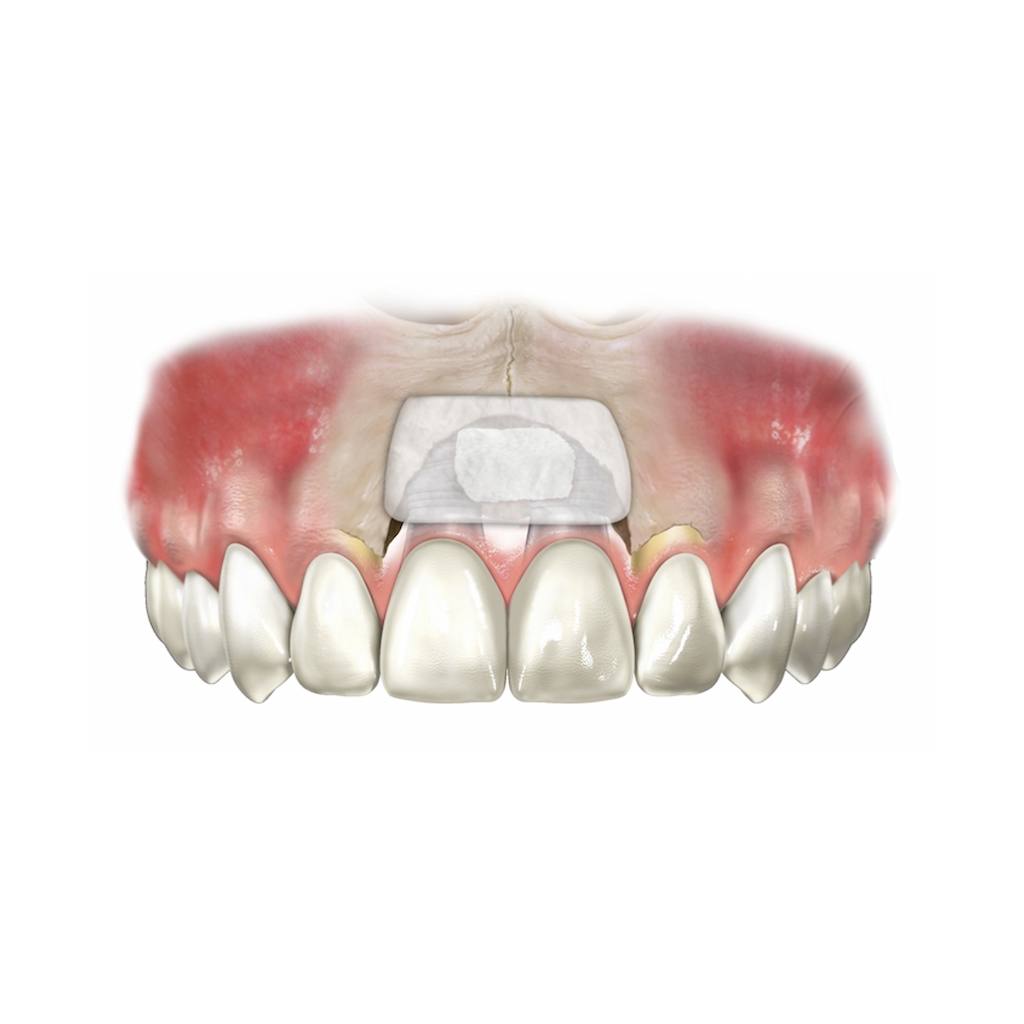 UBGEN-Bone-Substitutes-AVPMedTech-SHELTER_4