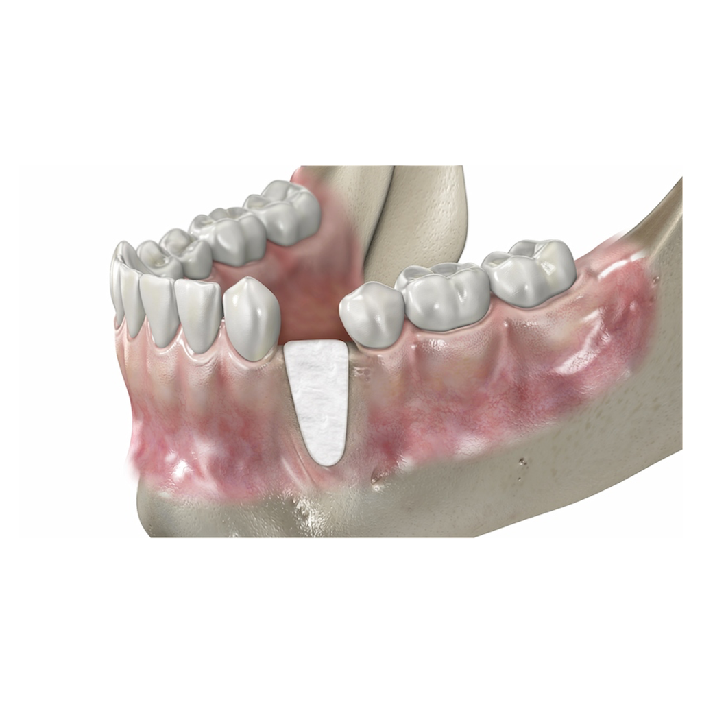UBGEN-Bone-Substitutes-AVPMedTech-SHELTER_5