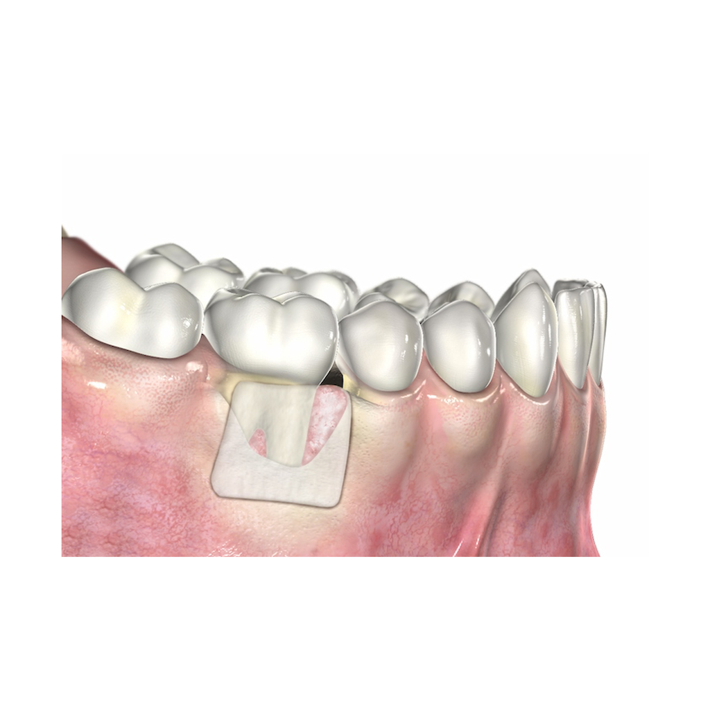 UBGEN-Bone-Substitutes-AVPMedTech-SHELTER_6