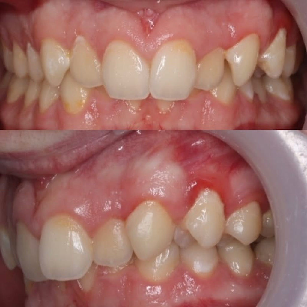 AVPMedTech-Dr-Luc-Arzel-TP-collage-finition-orthodontique-vers-traitements-plus-rapides-maitrises-2026_cas_1