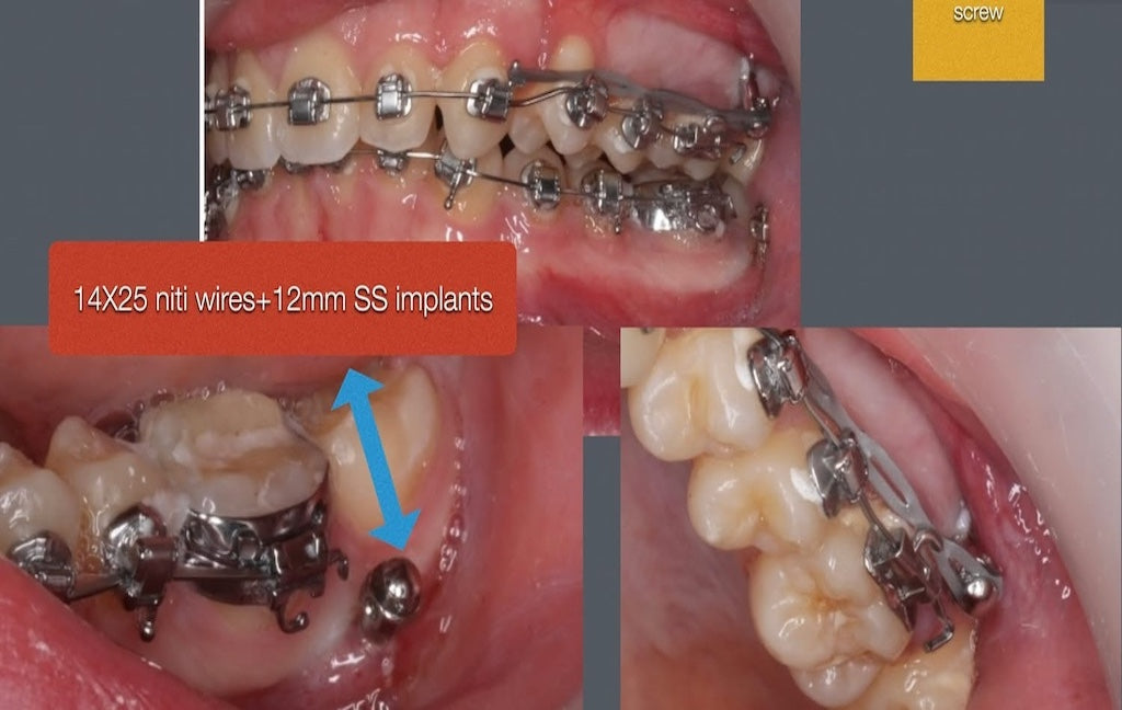AVPMedTech-Dr-Luc-Arzel-TP-collage-finition-orthodontique-vers-traitements-plus-rapides-maitrises-2026_cas_2