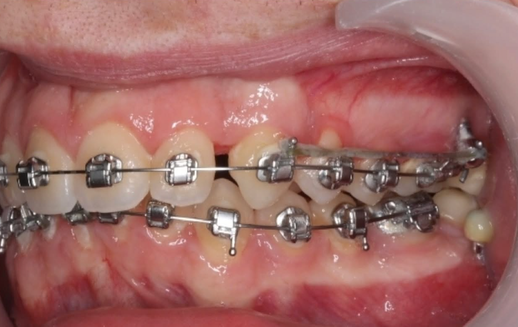 AVPMedTech-Dr-Luc-Arzel-TP-collage-finition-orthodontique-vers-traitements-plus-rapides-maitrises-2026_cas_3
