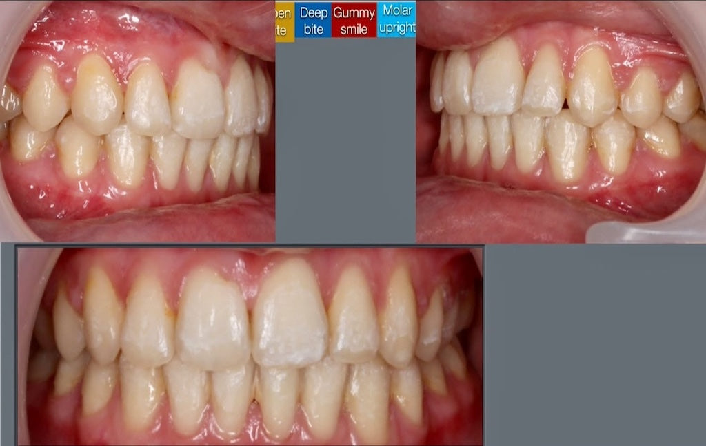 AVPMedTech-Dr-Luc-Arzel-TP-collage-finition-orthodontique-vers-traitements-plus-rapides-maitrises-2026_cas_4