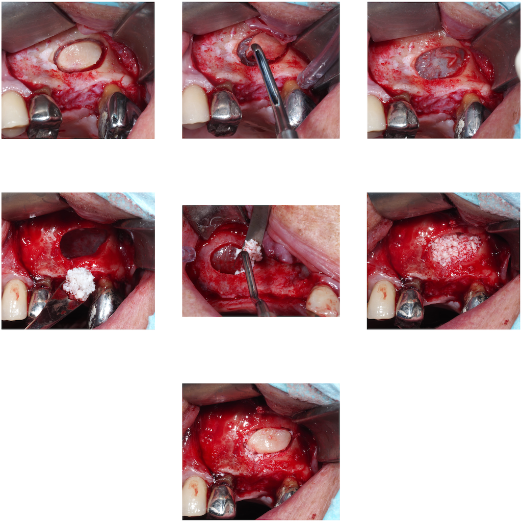 AVPMedTech-Dr-Olivier-Samtmann-TP-formation-sinus-lift-paris-2026-cas-clinique-3