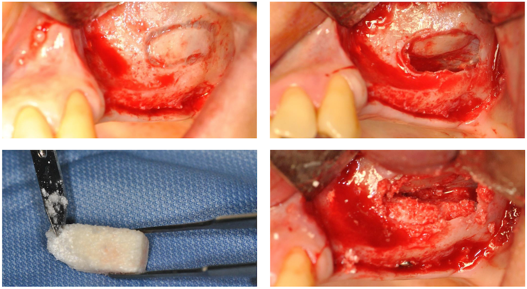 AVPMedTech-TP-formation-sinus-lift-paris-2026-UBGEN-cas-clinique-1