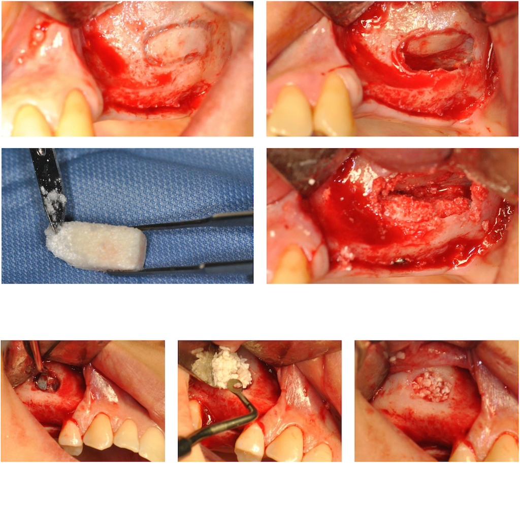 AVPMedTech-TP-formation-sinus-lift-paris-2026-UBGEN-cas-clinique-photo-1