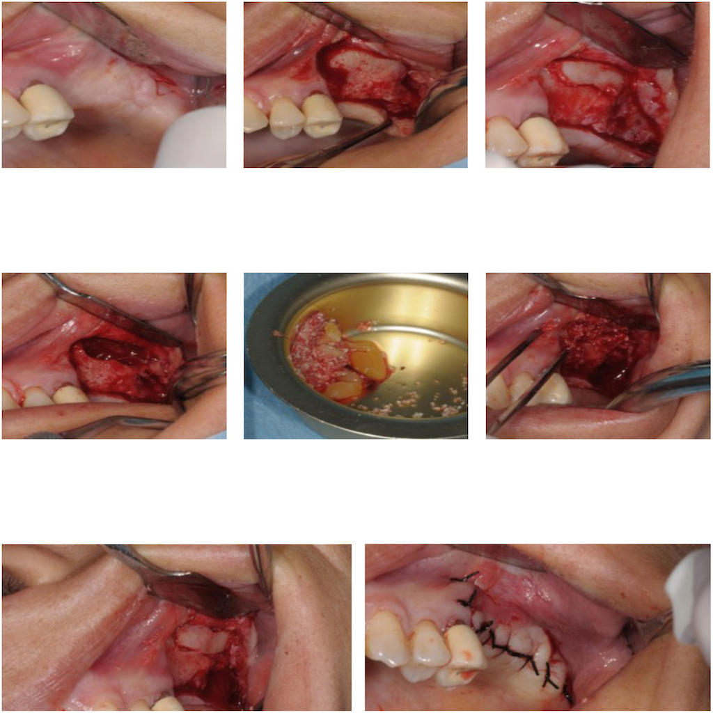 AVPMedTech-TP-formation-sinus-lift-paris-2026-UBGEN-cas-clinique-photo2