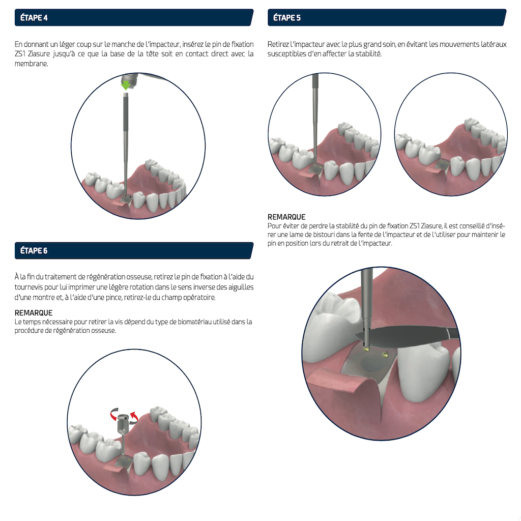 AVPMedTech-instruments-pins-de-fixation-protocol-2